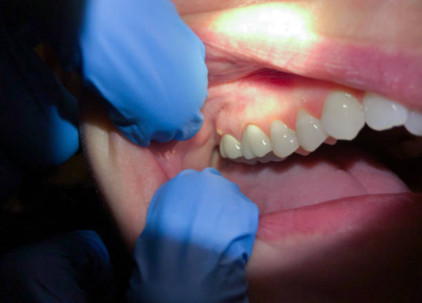 Best Emergency Dental Care for Broken or Chipped Teeth in Franklin, MI
